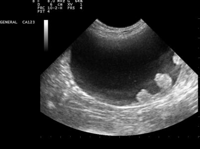 Bladder Ultrasound showing a tumour